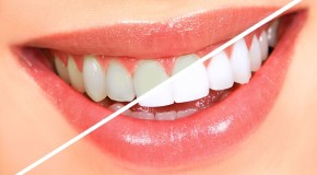 Czy wybielanie zębów ma sens?