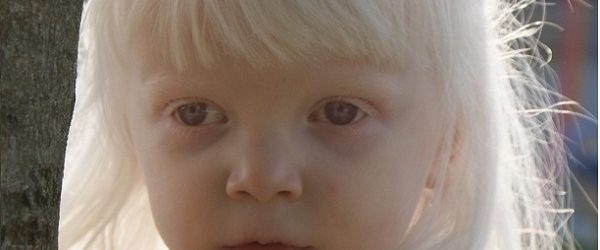 Albinizm i jego skutki