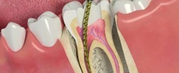 Leczenie kanałowe zębów